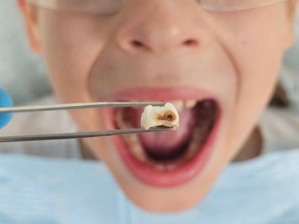 Best Tooth Infection Emergency Dentist  in Galliano, LA